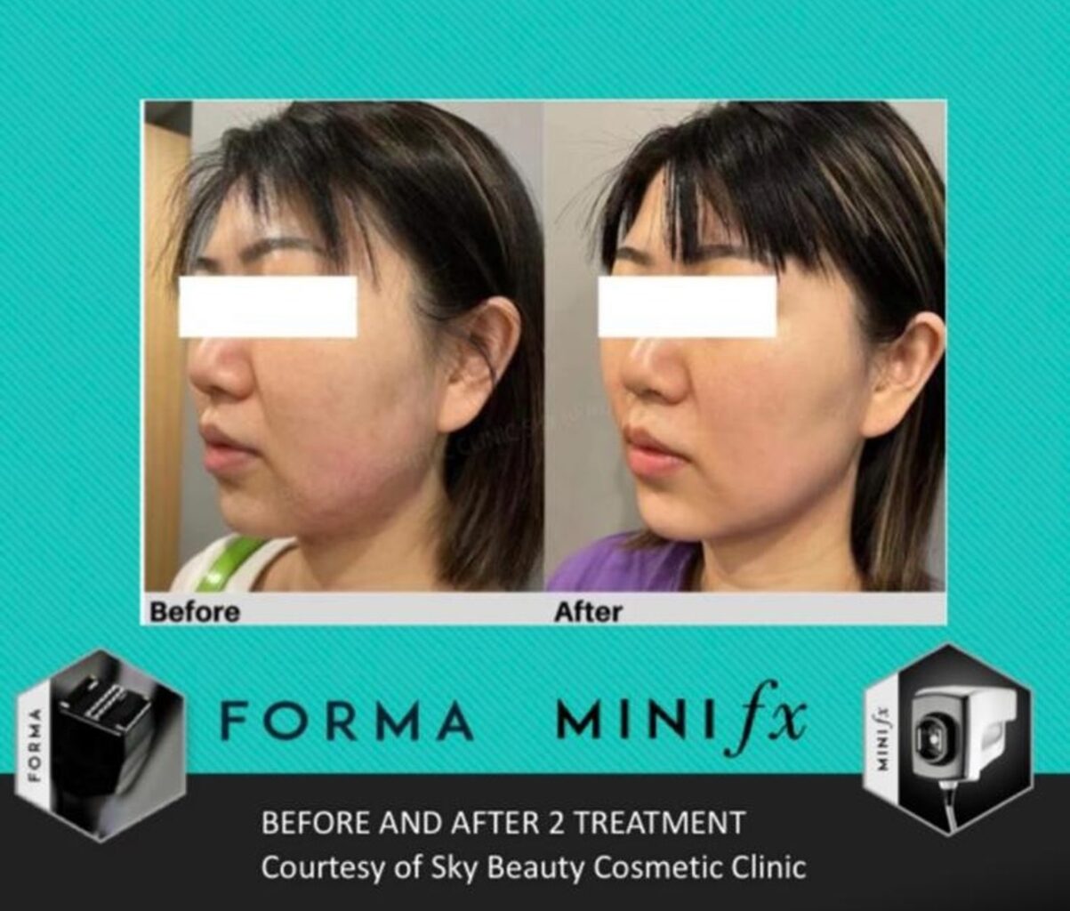 雙下巴怎麼瘦？鑽石超塑術後療程比對01