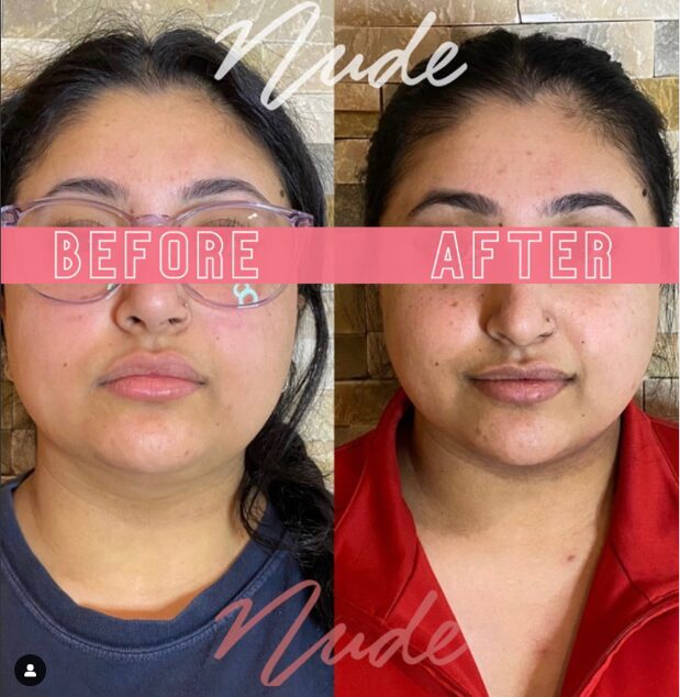 鑽石超塑術後療程比對02