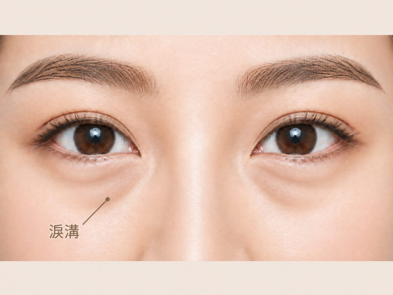 淚溝示意圖